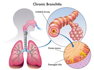 chronic-bronchitis