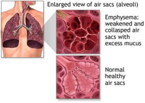 Emphysema_Diagram