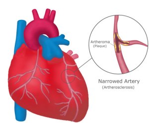 Heart-&-narrowed-artery