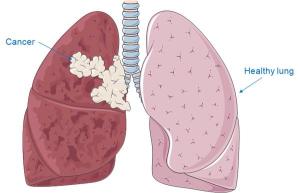 Lung_Cancer